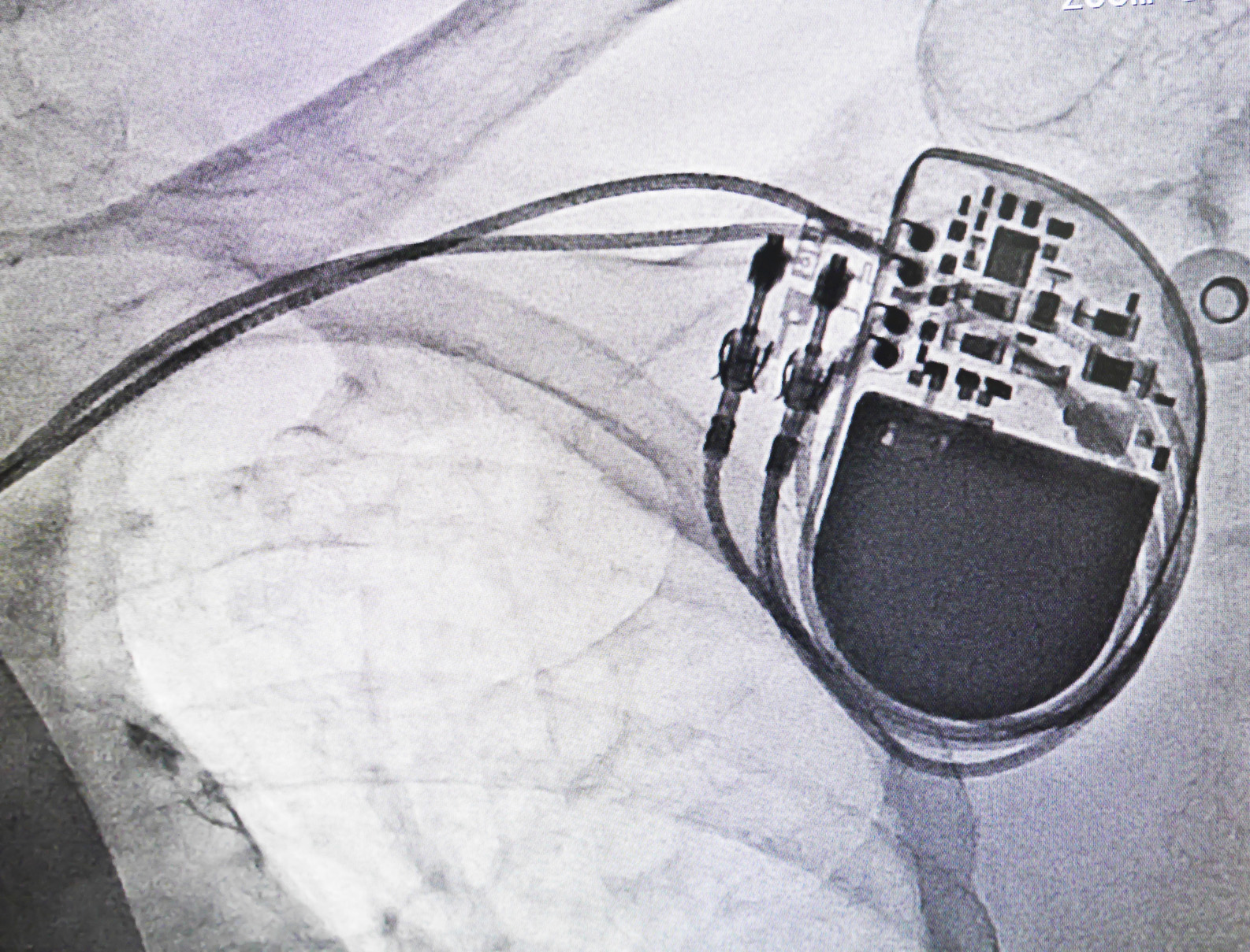 Permanent pacemaker x-ray image in cardiac catheterization