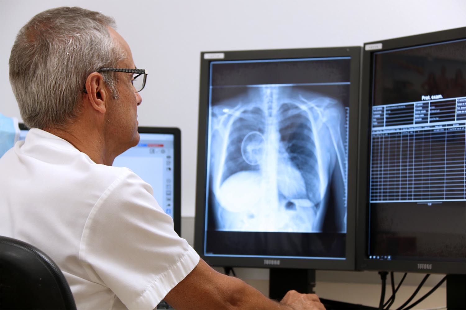Cáncer de pulmón en radiografías