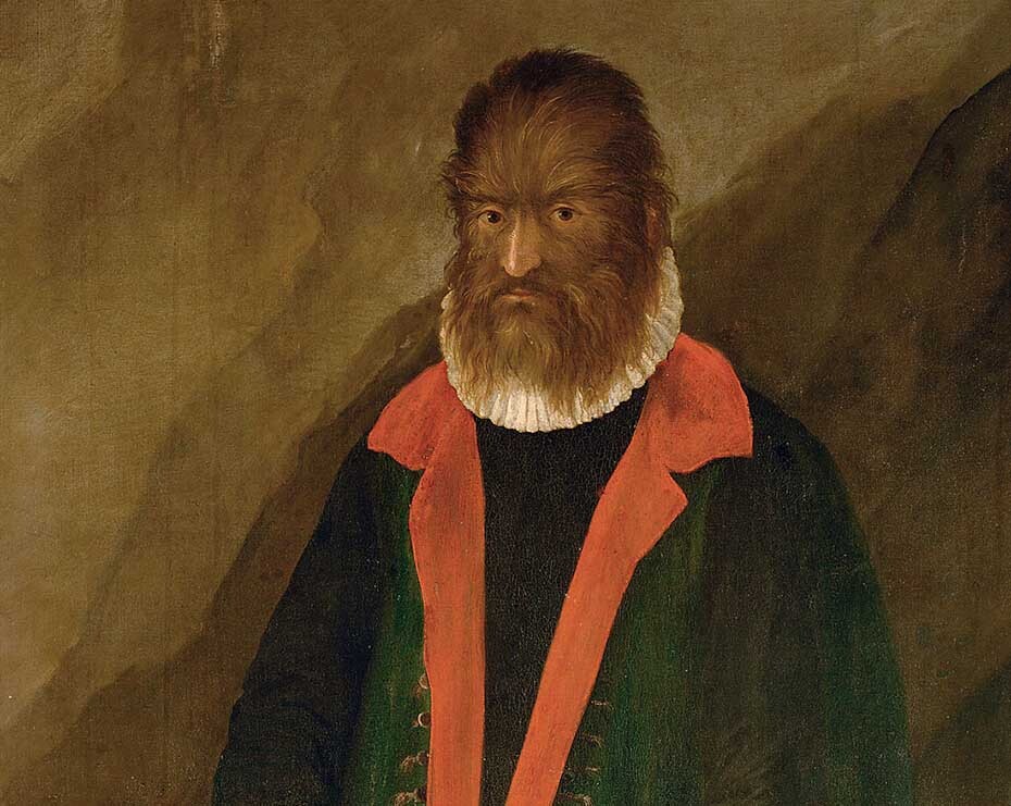 Petrus Gonsalvus fue uno de los primeros casos registrados de hipertricosis.