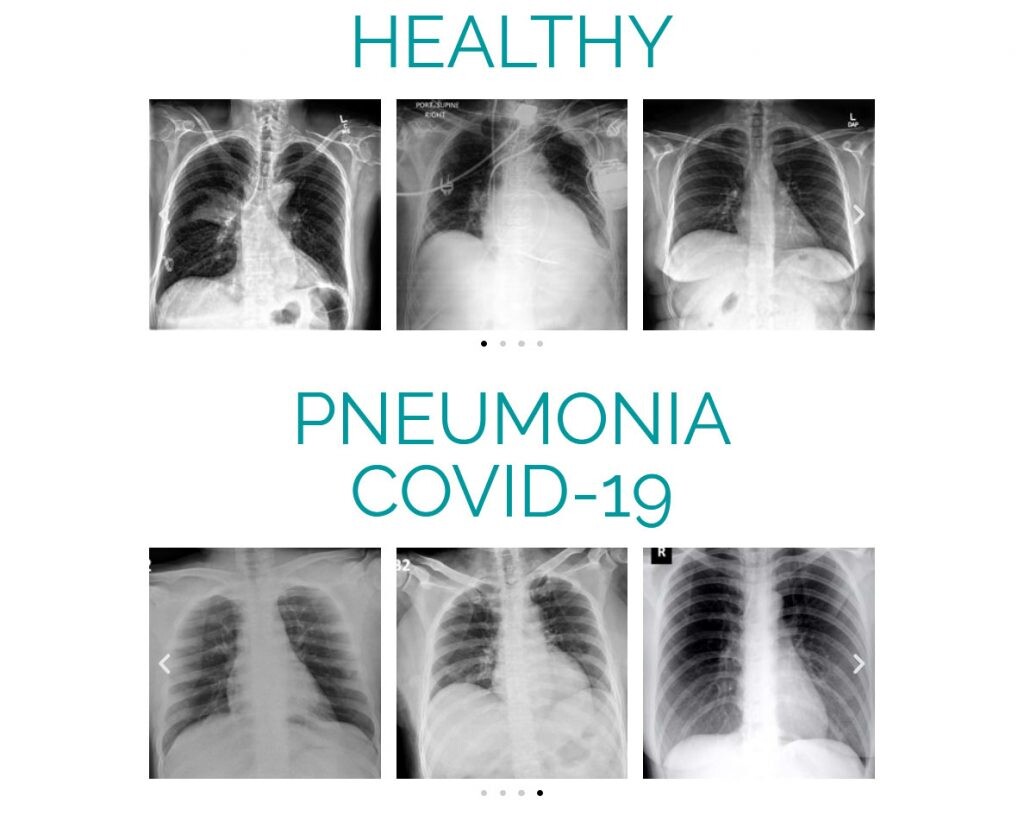radiografías de pulmones COVID-19