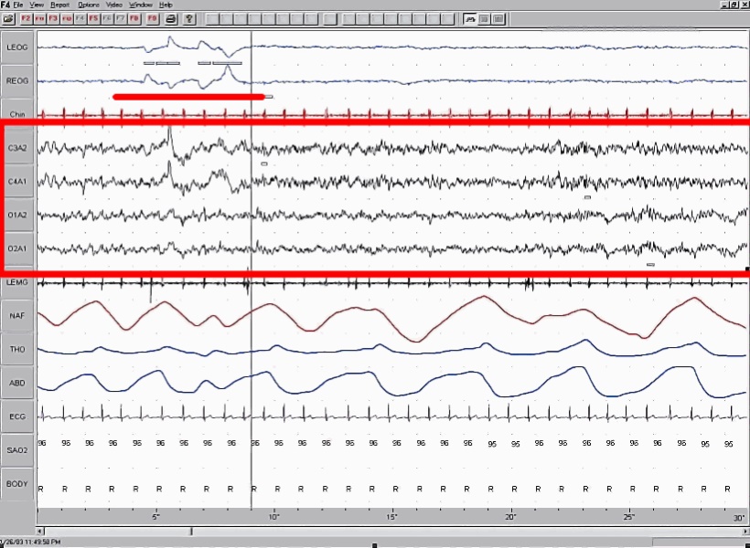 Un encefalograma con sueño paradójico. Los movimientos oculares rápidos señalados por una línea roja. Foto de Wikipedia