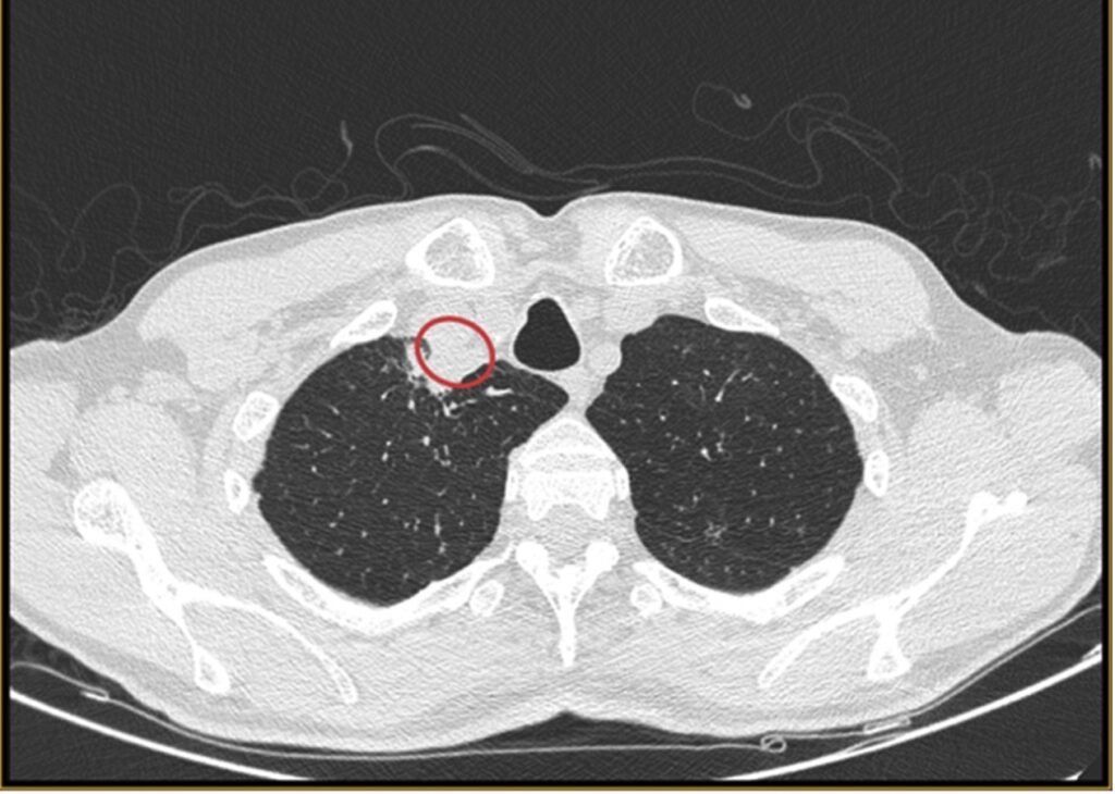 Radiografía de la infección del hongo Chondrostereum purpureum encontrada en un humano