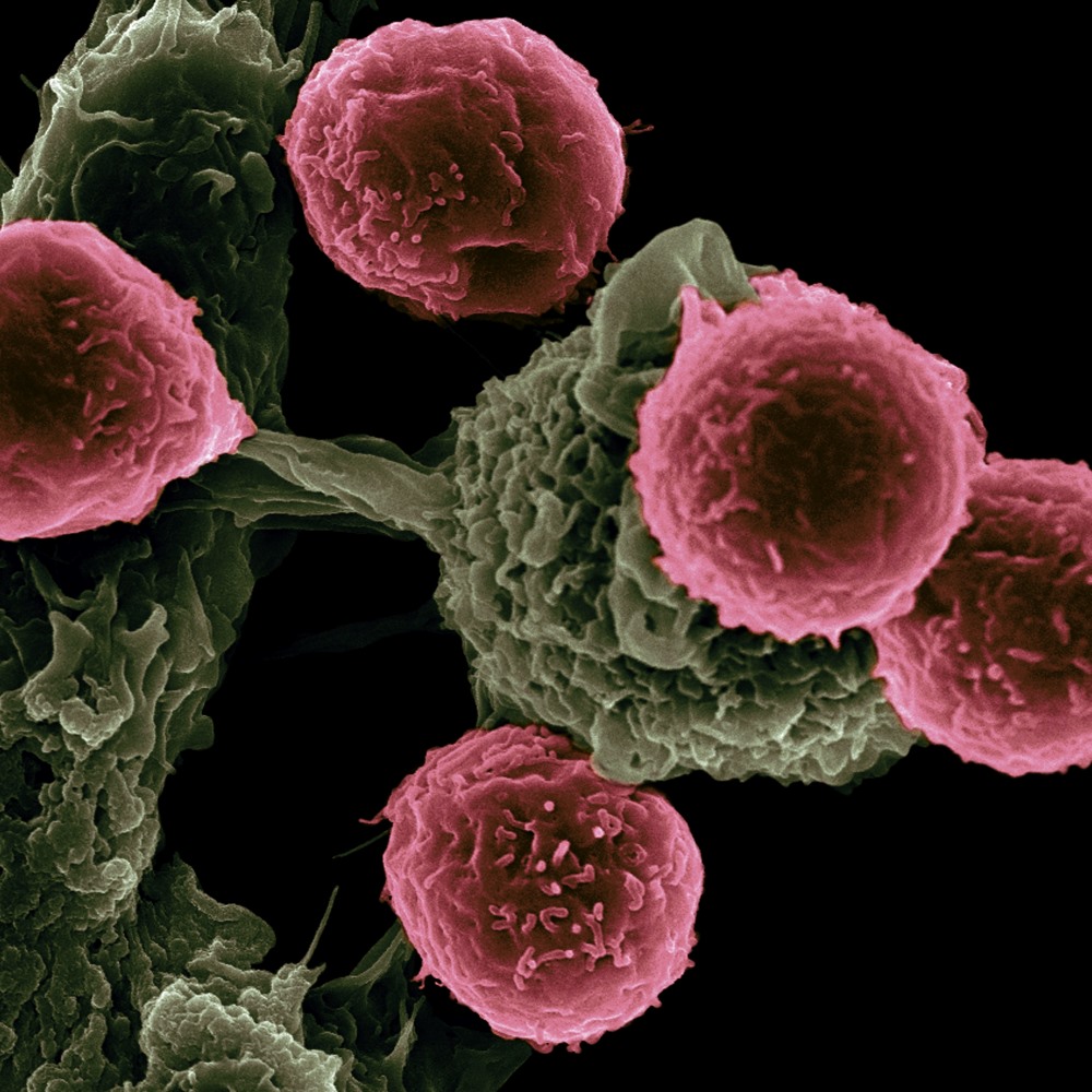 Imagen microscópica de un cáncer